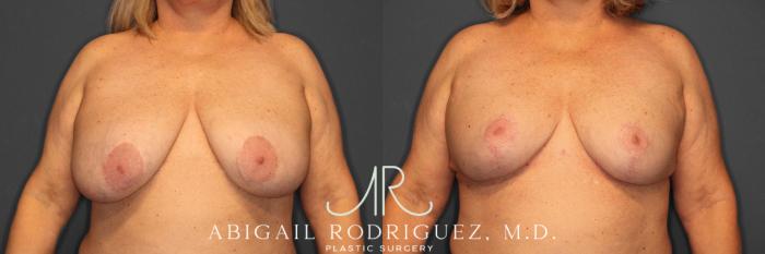 Before & After Breast Revision Case 258563 View 1 View in Houston, TX