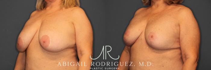 Before & After Breast Revision Case 258563 View 3 View in Houston, TX