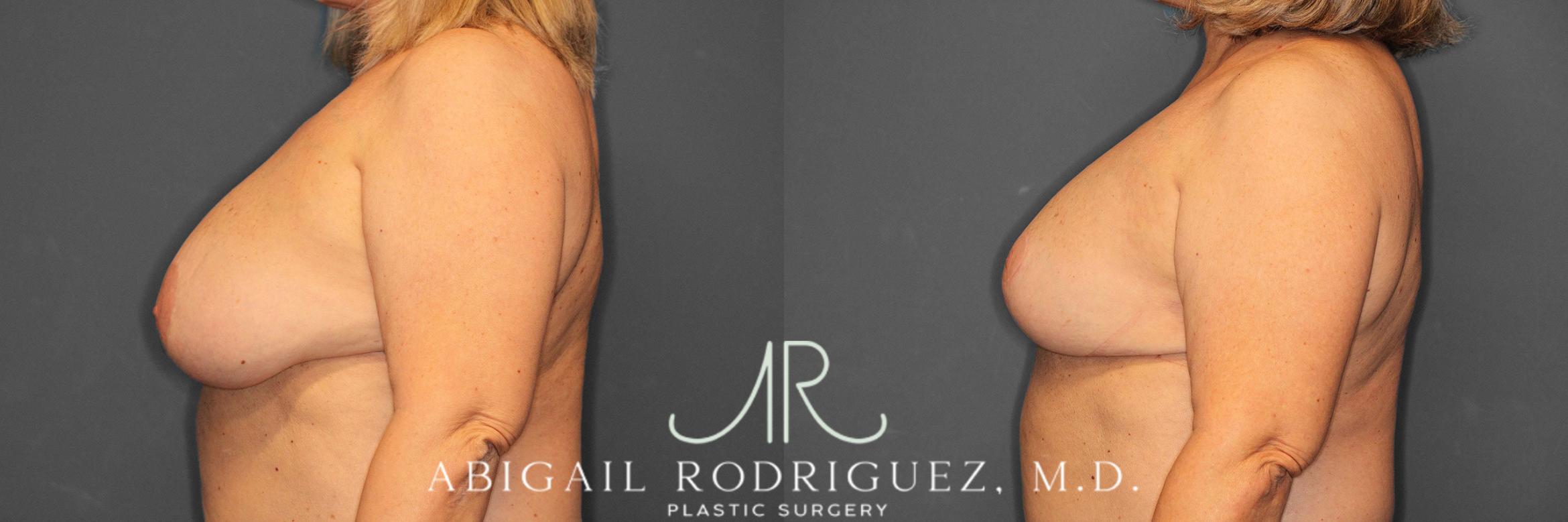 Before & After Breast Revision Case 258563 View 4 View in Houston, TX