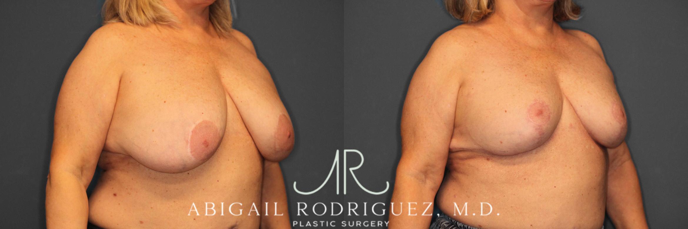 Before & After Breast Revision Case 258563 View 5 View in Houston, TX