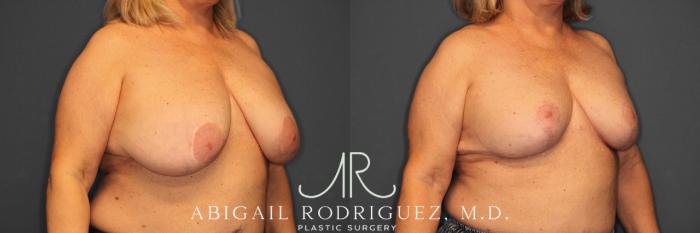 Before & After Breast Revision Case 258563 View 5 View in Houston, TX