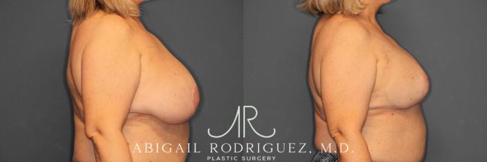Before & After Breast Revision Case 258563 View 6 View in Houston, TX