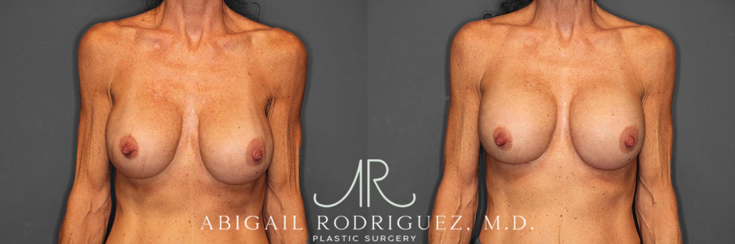 Before & After Breast Revision Case 258603 View 1 View in Houston, TX