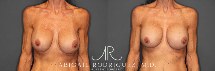 Before & After Breast Revision Case 258603 View 1 View in Houston, TX
