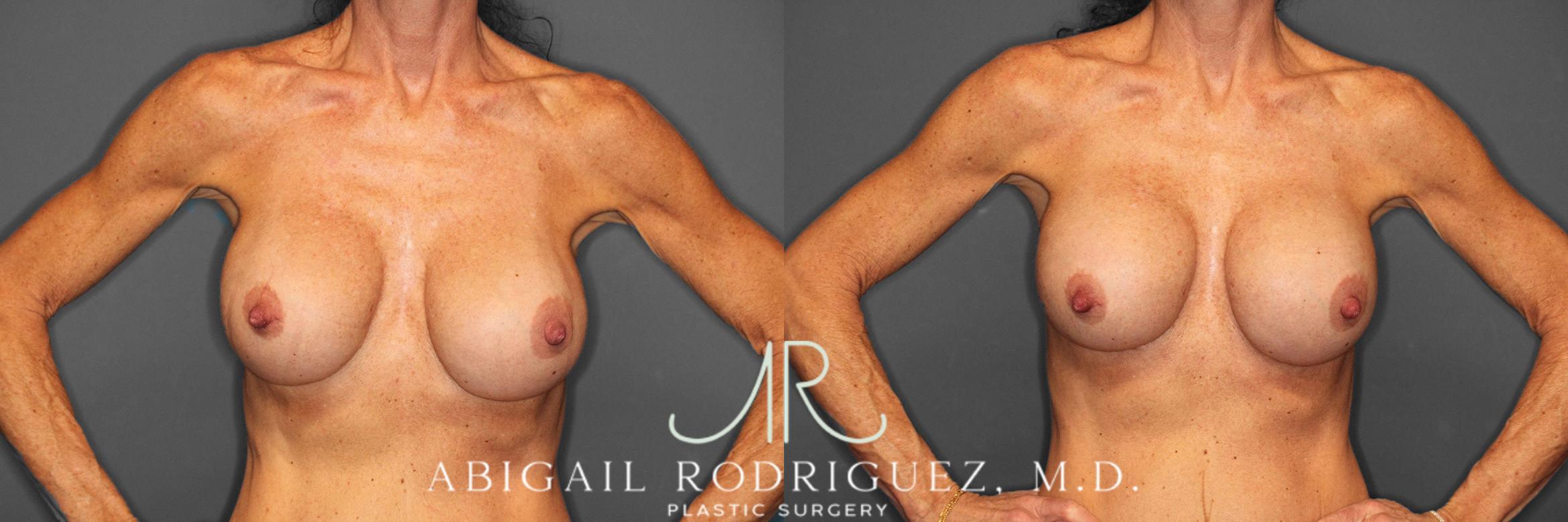 Before & After Breast Revision Case 258603 View 2 View in Houston, TX