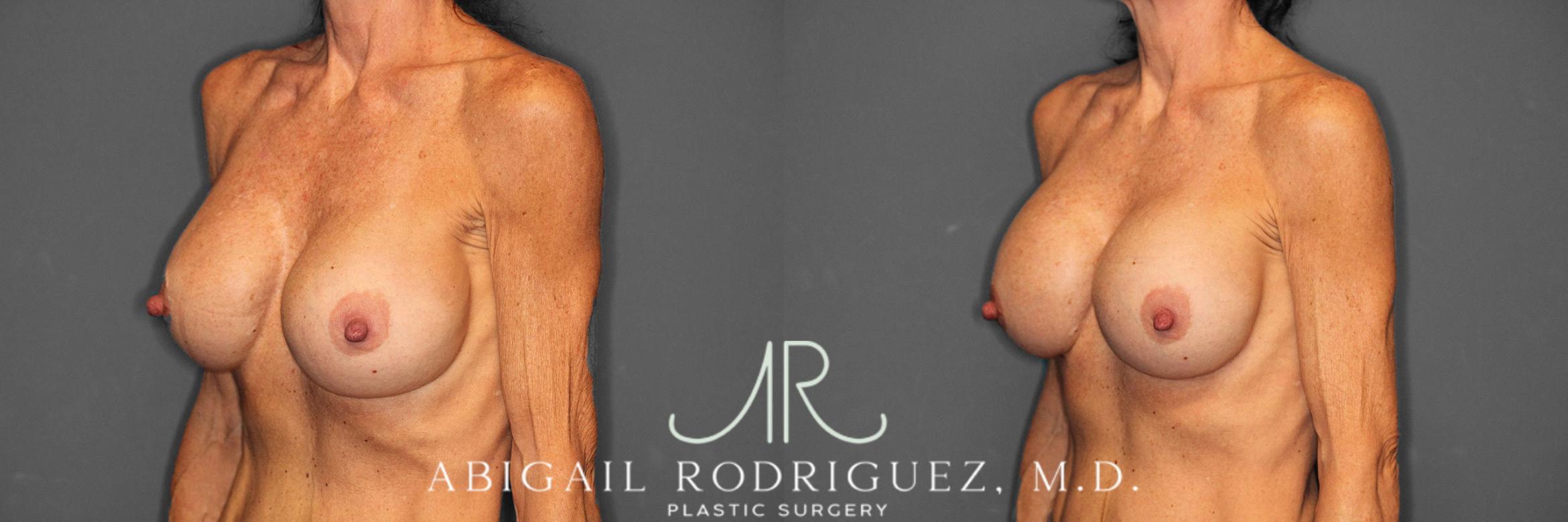 Before & After Breast Revision Case 258603 View 3 View in Houston, TX