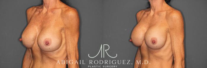 Before & After Breast Revision Case 258603 View 3 View in Houston, TX