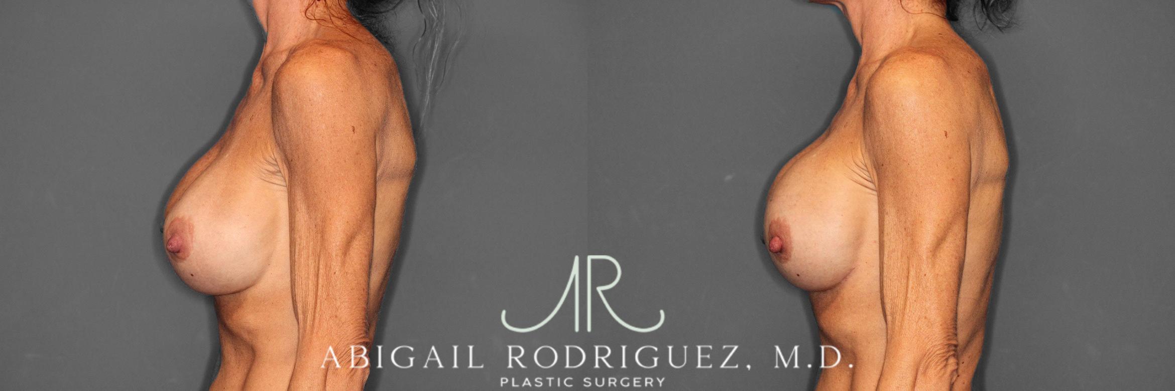 Before & After Breast Revision Case 258603 View 4 View in Houston, TX