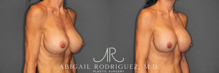 Before & After Breast Revision Case 258603 View 5 View in Houston, TX