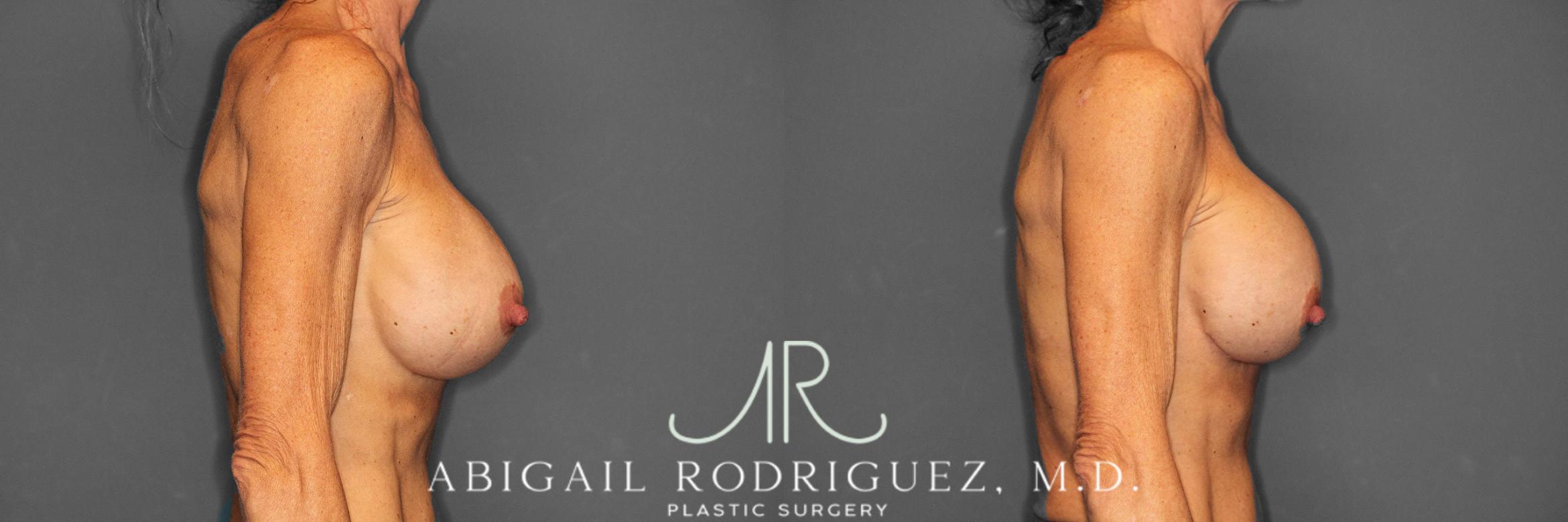 Before & After Breast Revision Case 258603 View 6 View in Houston, TX