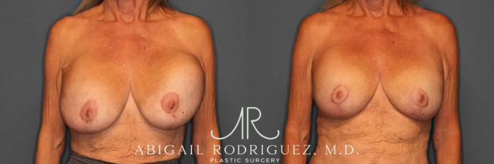 Before & After Breast Revision Case 259002 View 1 View in Houston, TX