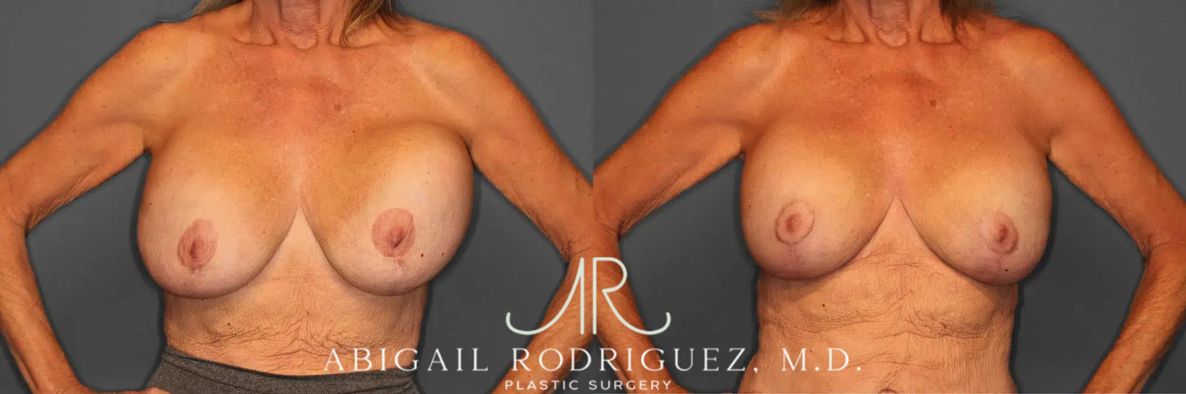 Before & After Breast Revision Case 259002 View 2 View in Houston, TX