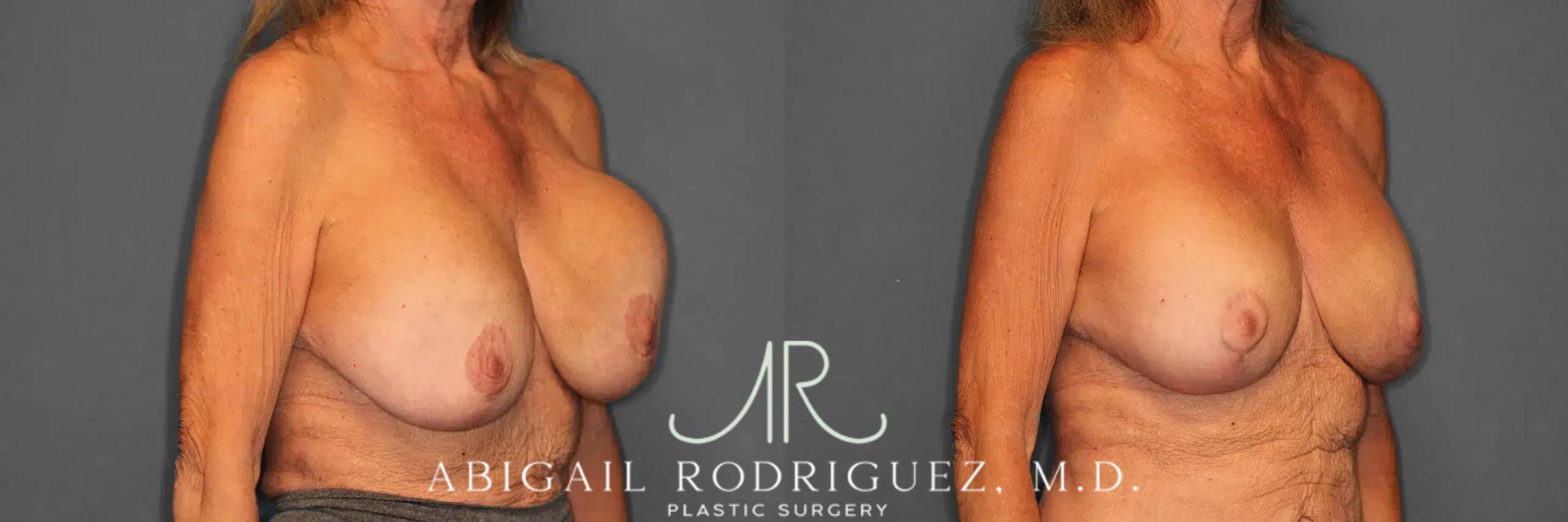 Before & After Breast Revision Case 259002 View 3 View in Houston, TX