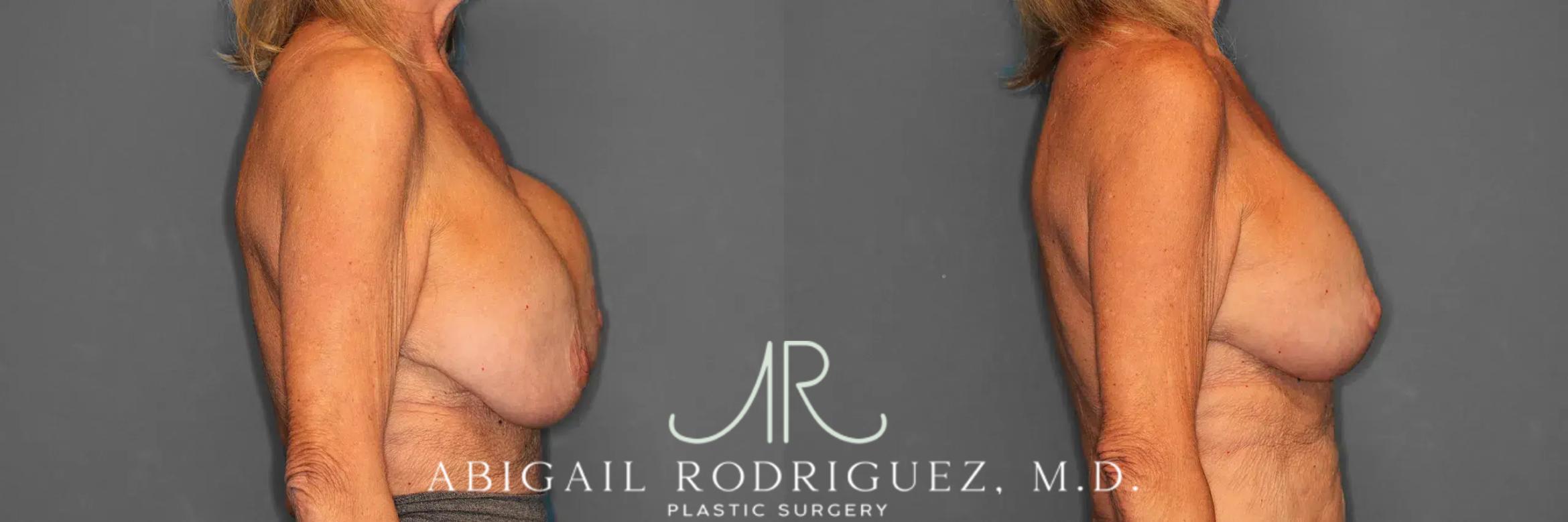 Before & After Breast Revision Case 259002 View 4 View in Houston, TX