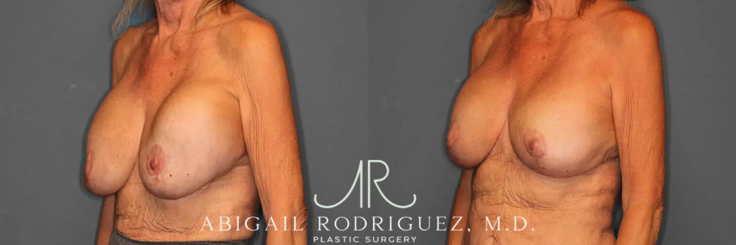 Before & After Breast Revision Case 259002 View 5 View in Houston, TX