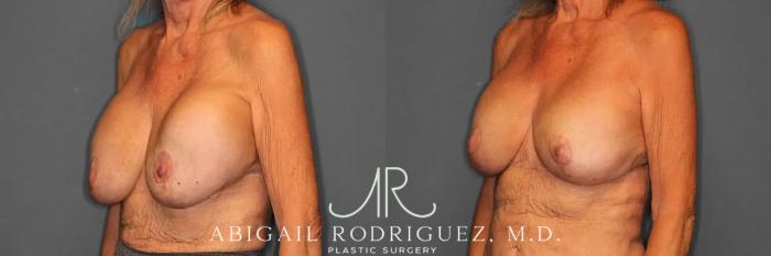 Before & After Breast Revision Case 259002 View 5 View in Houston, TX