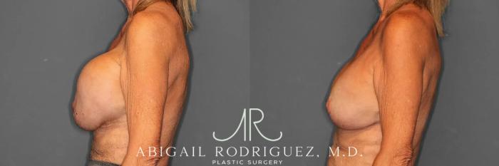 Before & After Breast Revision Case 259002 View 6 View in Houston, TX