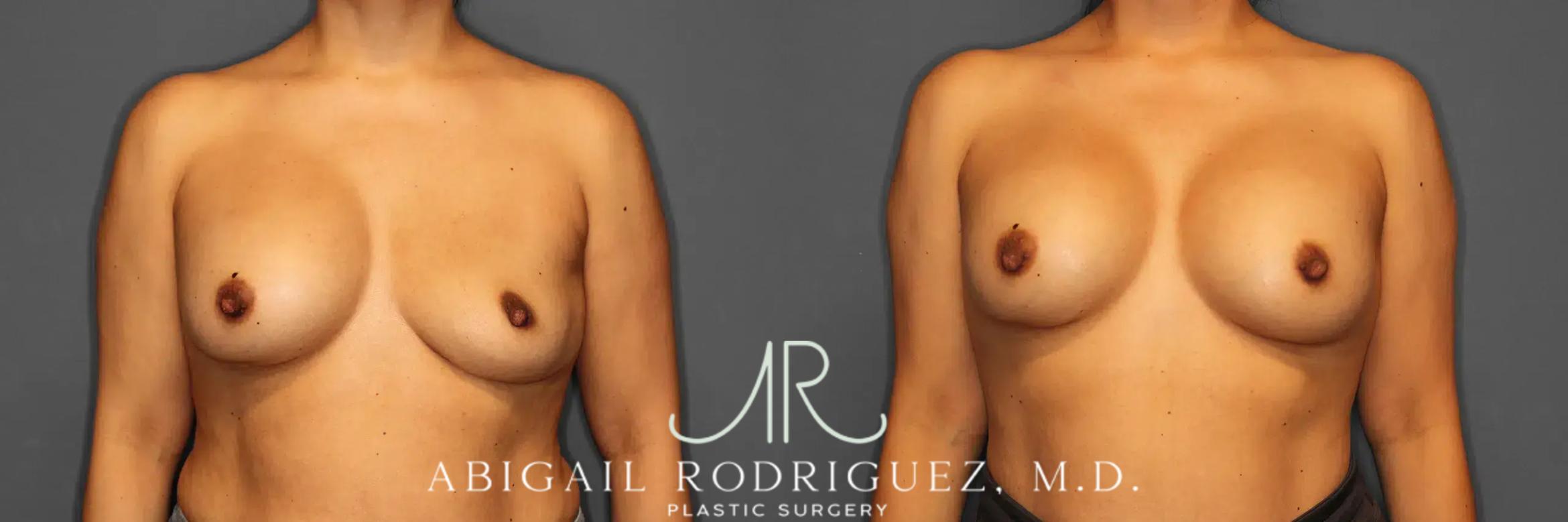 Before & After Breast Revision Case 259050 View 1 View in Houston, TX