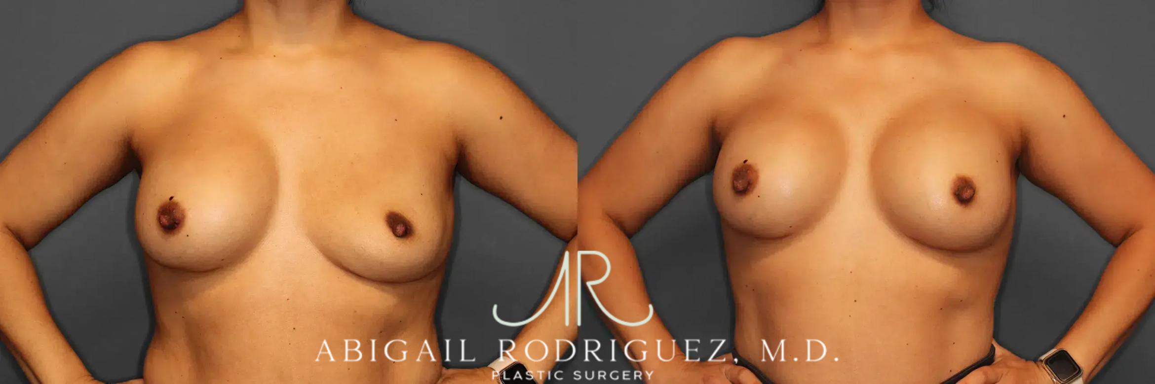 Before & After Breast Revision Case 259050 View 2 View in Houston, TX