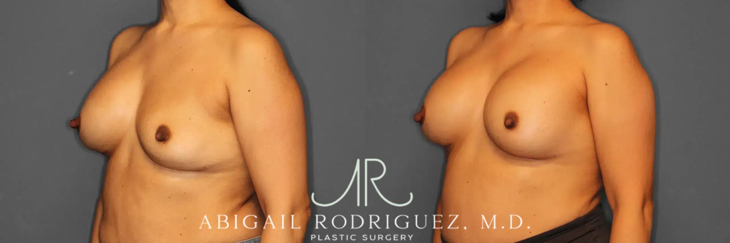 Before & After Breast Revision Case 259050 View 3 View in Houston, TX
