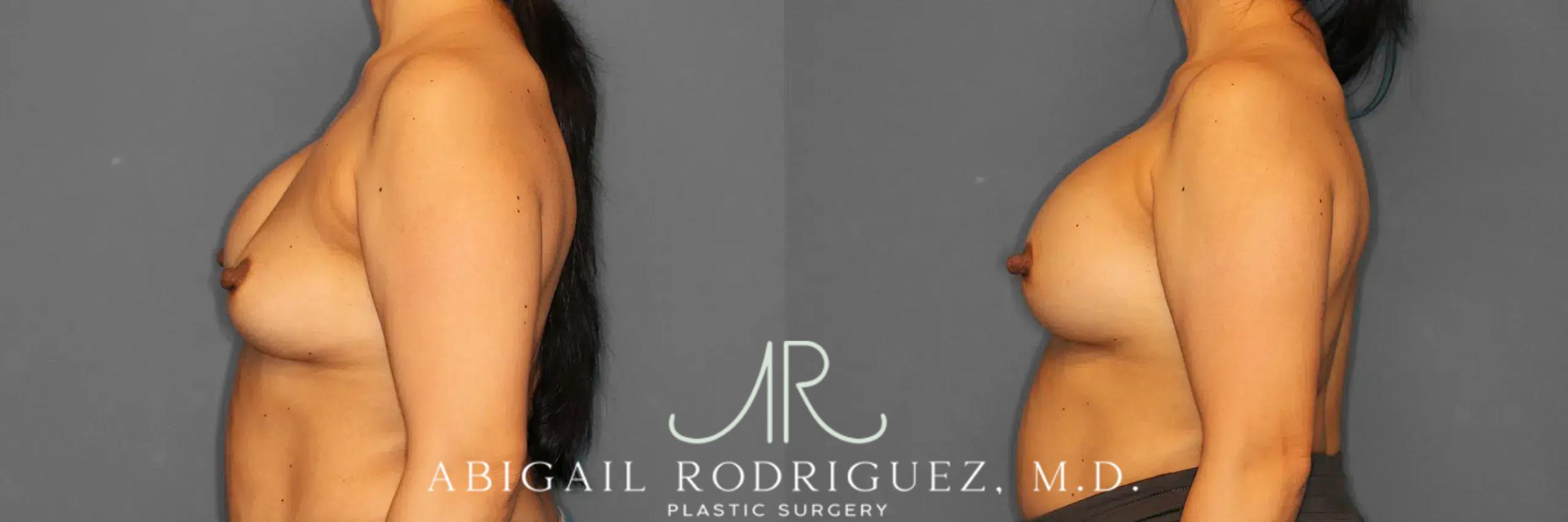 Before & After Breast Revision Case 259050 View 4 View in Houston, TX