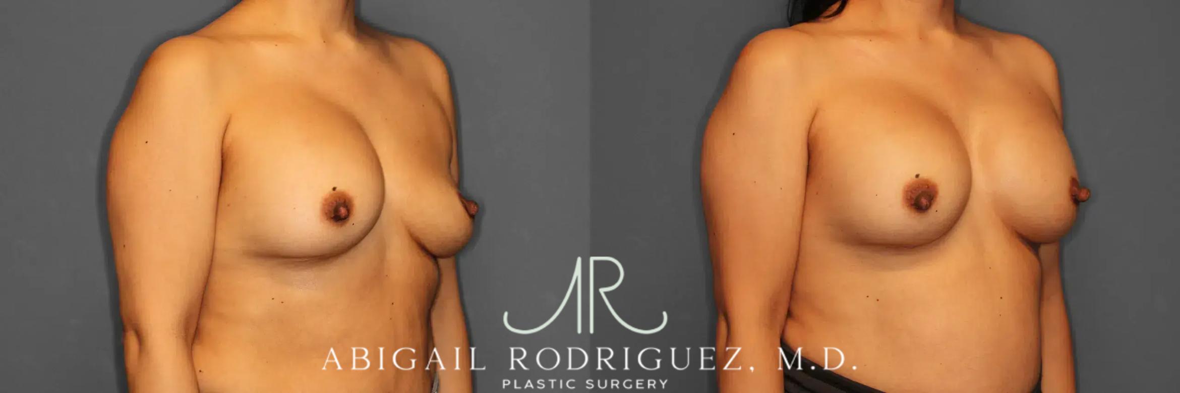 Before & After Breast Revision Case 259050 View 5 View in Houston, TX