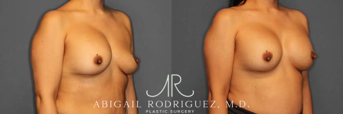 Before & After Breast Revision Case 259050 View 5 View in Houston, TX