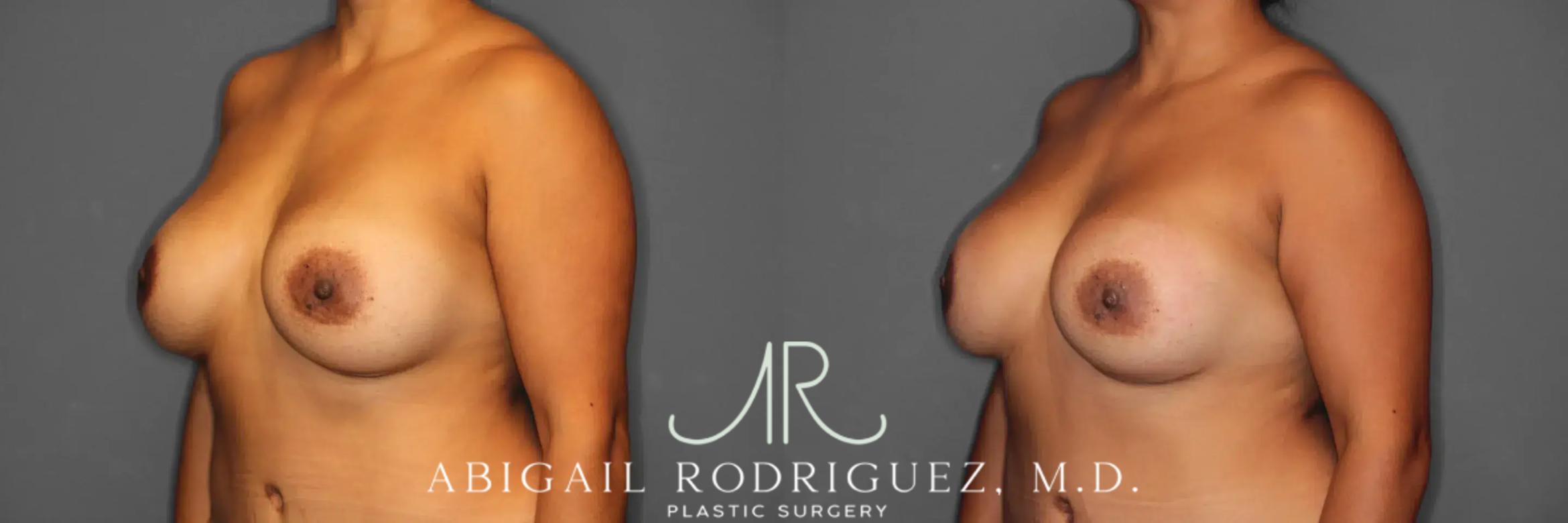 Before & After Breast Revision Case 259360 View 3 View in Houston, TX