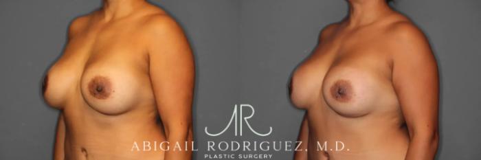 Before & After Breast Revision Case 259360 View 3 View in Houston, TX