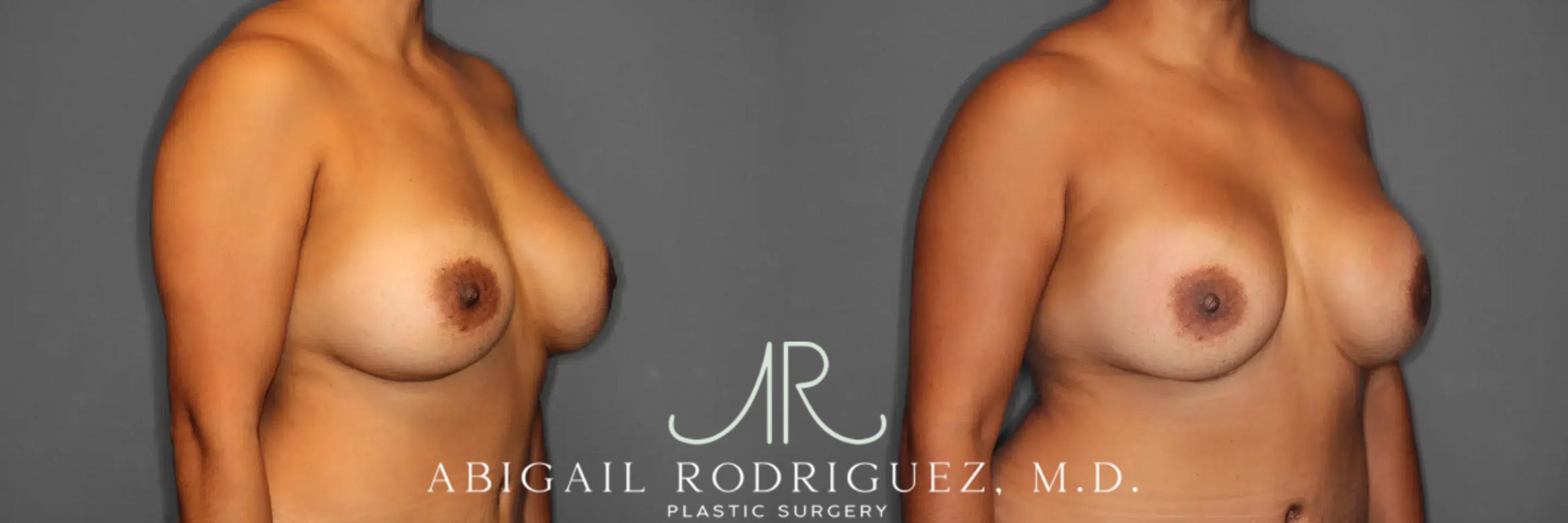 Before & After Breast Revision Case 259360 View 5 View in Houston, TX