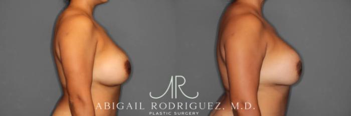 Before & After Breast Revision Case 259360 View 6 View in Houston, TX