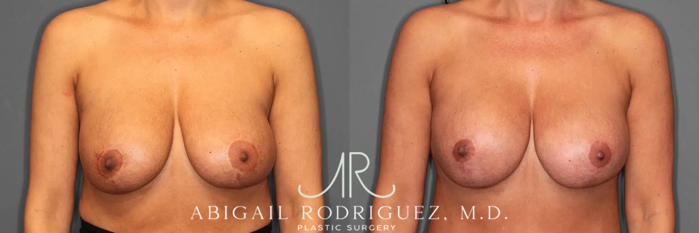 Before & After Breast Revision Case 259482 View 1 View in Houston, TX