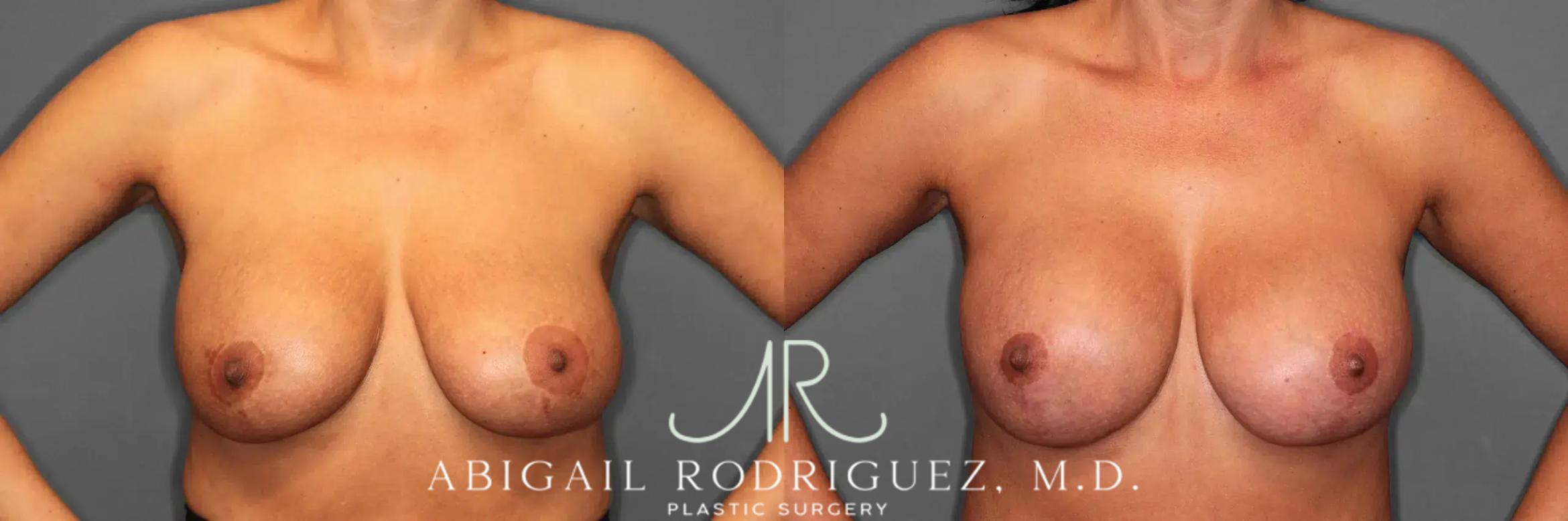 Before & After Breast Revision Case 259482 View 2 View in Houston, TX
