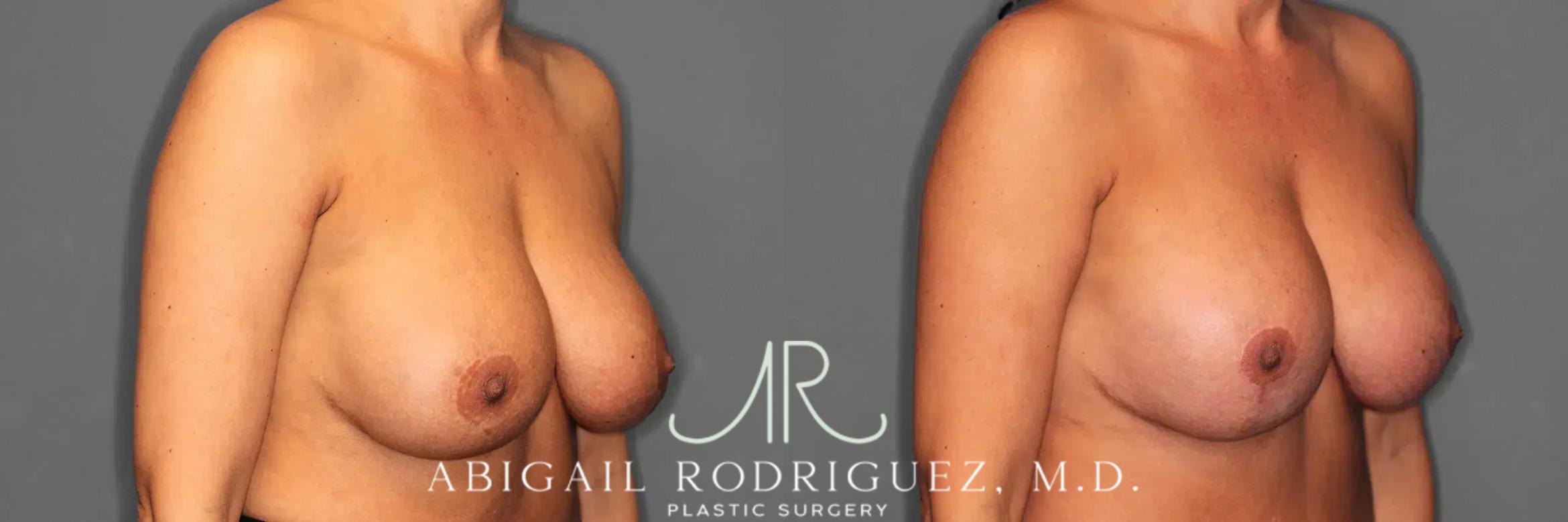 Before & After Breast Revision Case 259482 View 3 View in Houston, TX