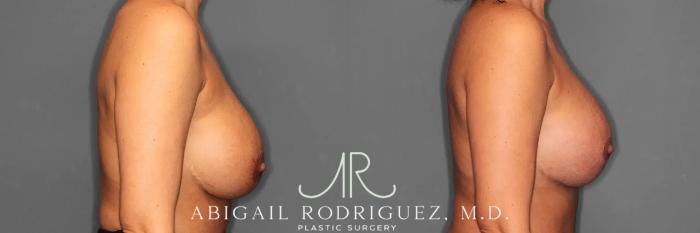 Before & After Breast Revision Case 259482 View 4 View in Houston, TX
