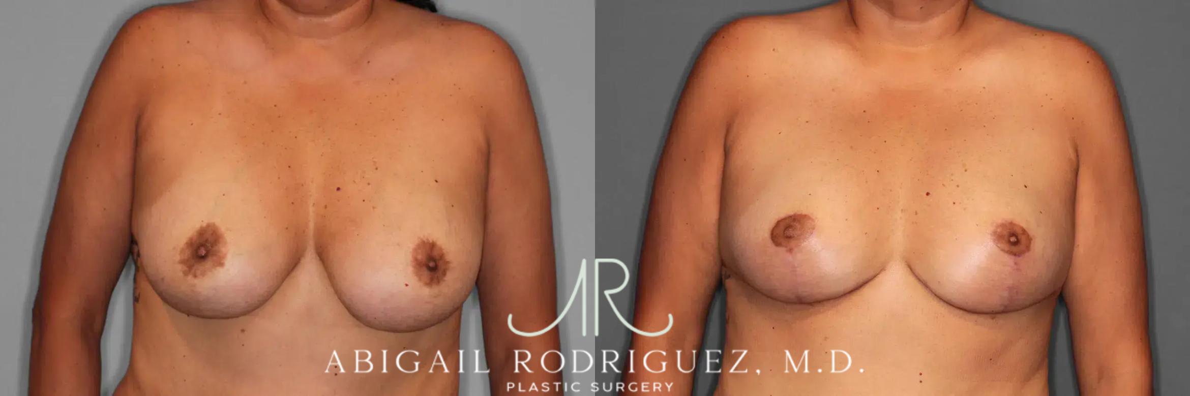 Before & After Breast Revision Case 259589 View 1 View in Houston, TX