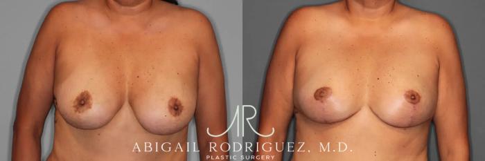 Before & After Breast Revision Case 259589 View 1 View in Houston, TX