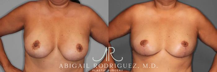 Before & After Breast Revision Case 259589 View 2 View in Houston, TX