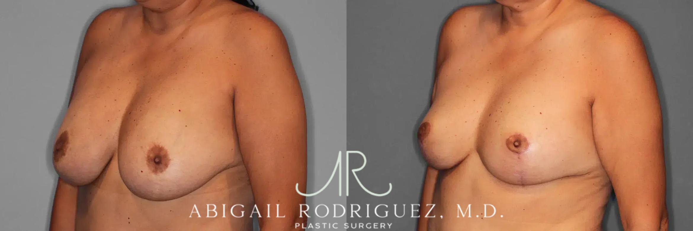 Before & After Breast Revision Case 259589 View 3 View in Houston, TX