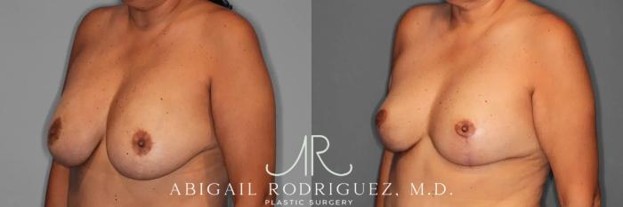 Before & After Breast Revision Case 259589 View 3 View in Houston, TX