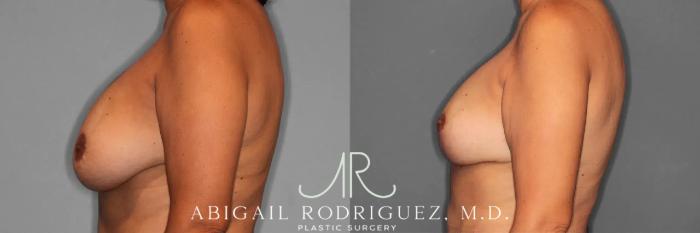 Before & After Breast Revision Case 259589 View 4 View in Houston, TX