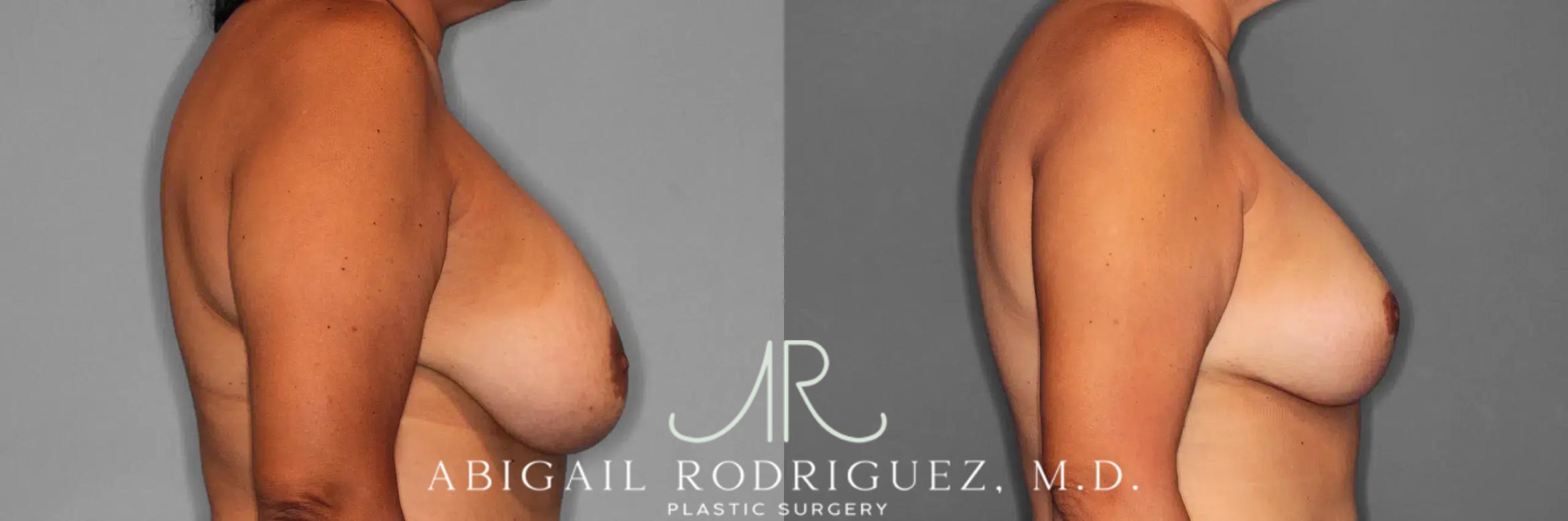 Before & After Breast Revision Case 259589 View 6 View in Houston, TX