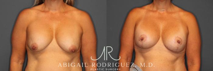 Before & After Breast Revision Case 345993 Front View in Houston, TX