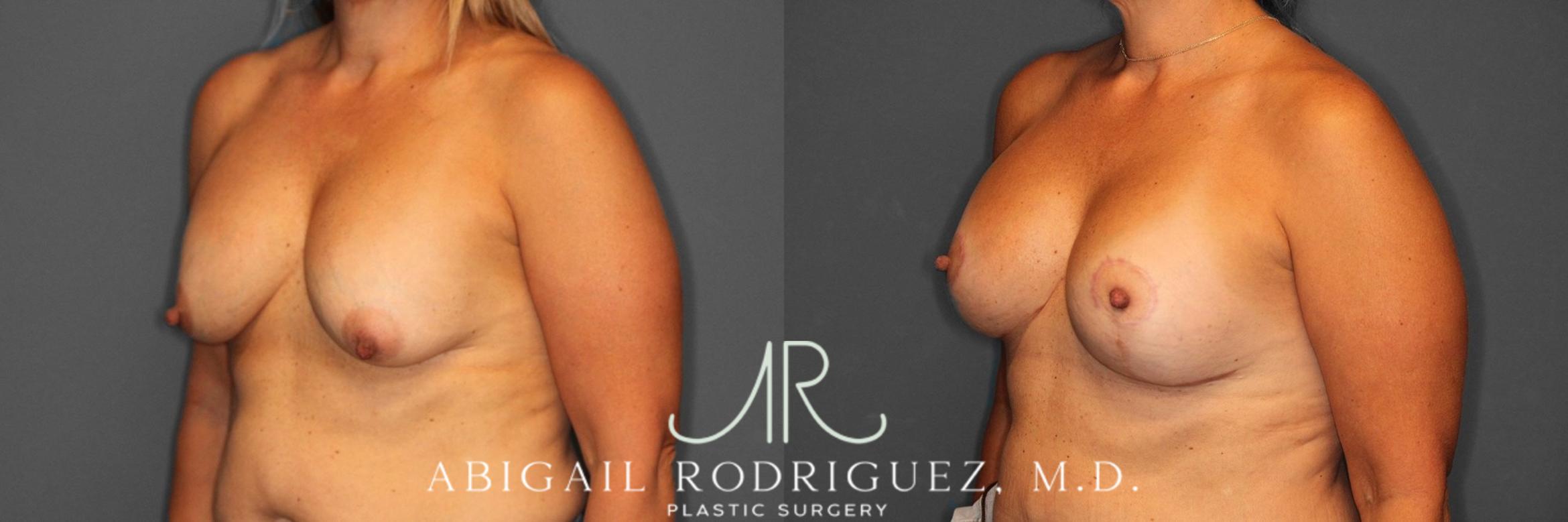 Before & After Breast Revision Case 345993 Left Oblique View in Houston, TX