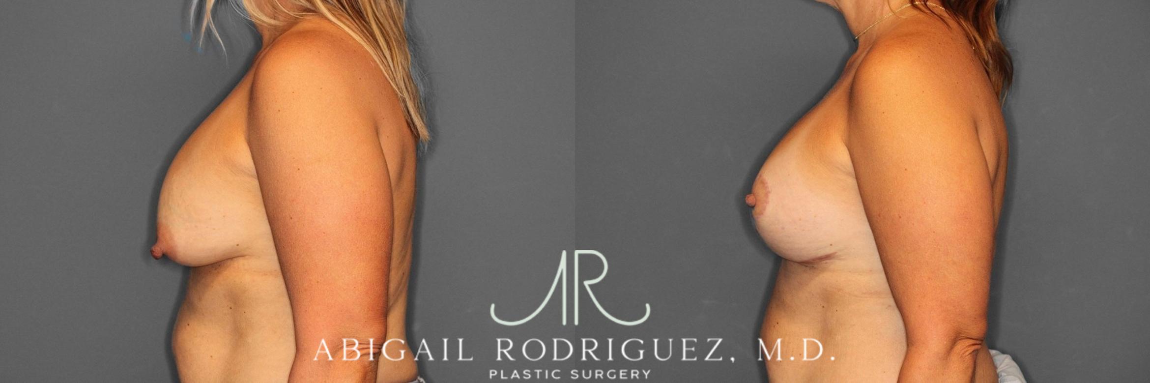 Before & After Breast Revision Case 345993 Left Side View in Houston, TX