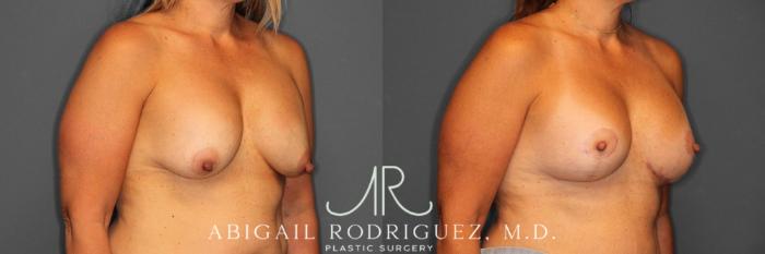 Before & After Breast Revision Case 345993 Right Oblique View in Houston, TX