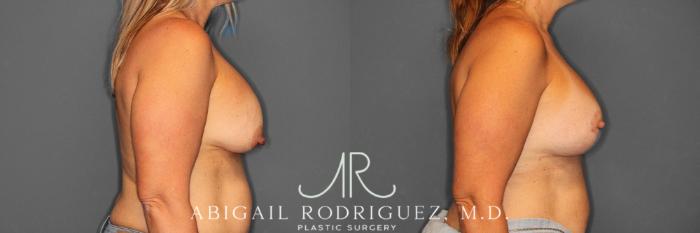 Before & After Breast Revision Case 345993 Right Side View in Houston, TX