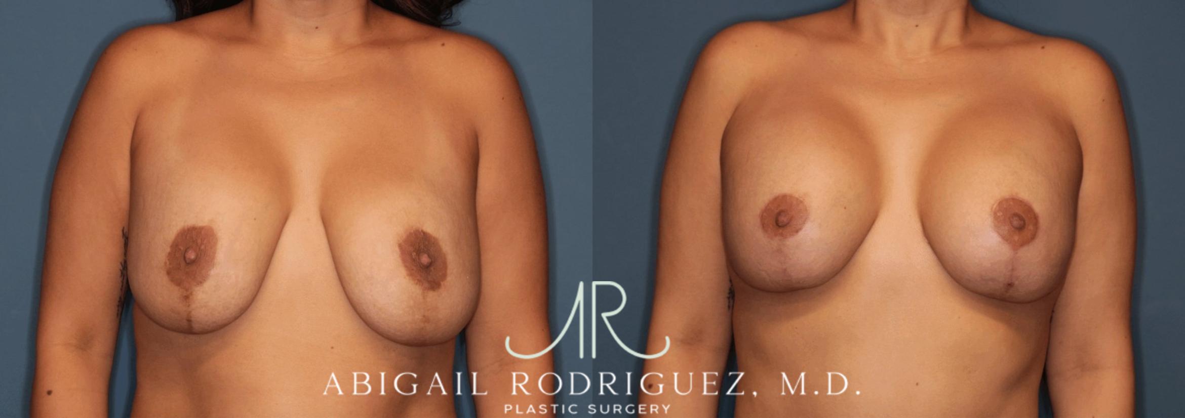 Before & After Breast Revision Case 346000 Front View in Houston, TX