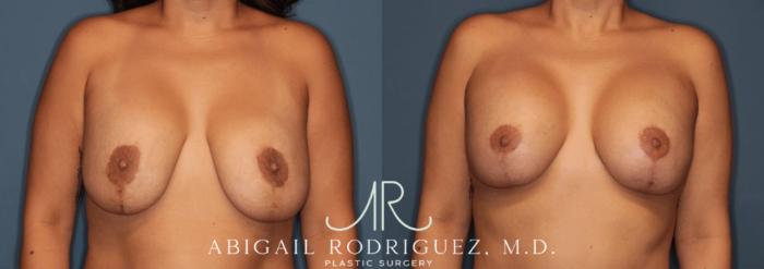 Before & After Breast Revision Case 346000 Front View in Houston, TX