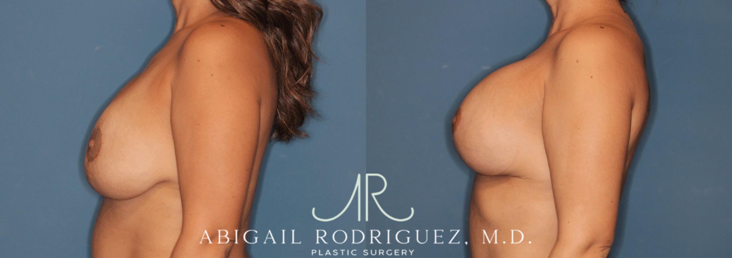 Before & After Breast Revision Case 346000 Left Side View in Houston, TX
